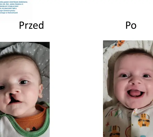 Uśmiechnięte dziecko z rozszczepem wargi przed i po operacji.