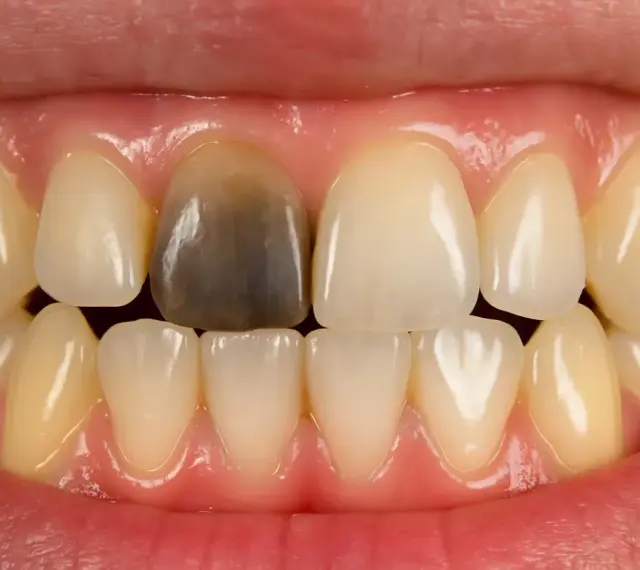 Ciemny, przebarwiony ząb może świadczyć o tym, jak sprawdzić czy ząb jest martwy. Zmiana koloru to sygnał, by udać się do dentysty.