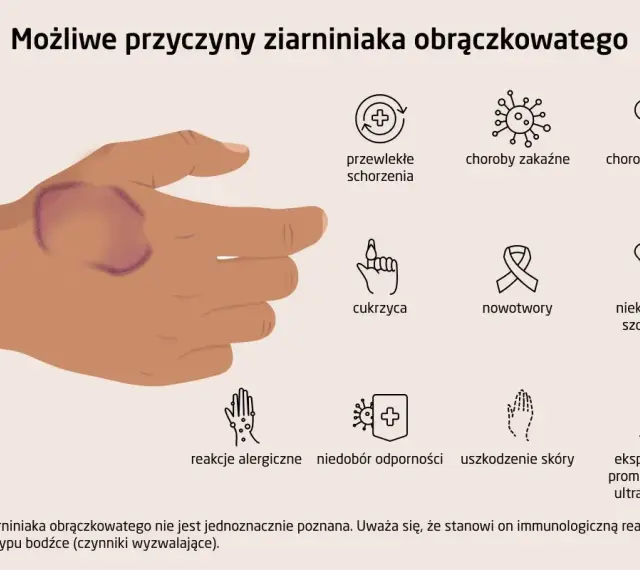 Dłoń z widocznym ziarniniakiem obrączkowatym. Obok ikony symbolizujące możliwe przyczyny: choroby, cukrzyca, nowotwory, leki, alergie, uszkodzenia skóry, promieniowanie UV.