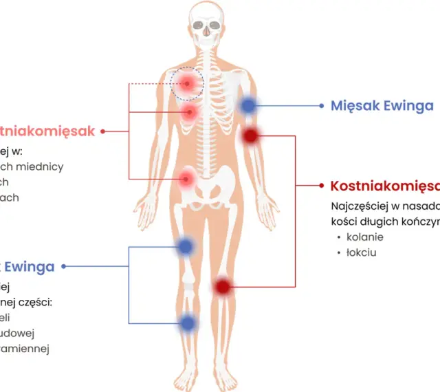 Schemat przedstawia lokalizację mięsaków: chrzęstniakomięsaka w miednicy, żebrach i łopatkach, a mięsaka Ewinga w piszczeli, kości udowej i ramiennej.