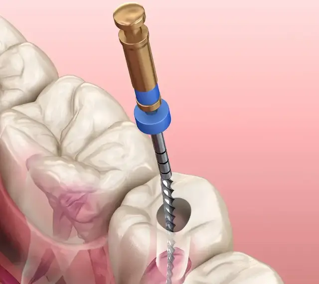 Ząb z ropą wymaga leczenia kanałowego. Dentysta używa narzędzia do oczyszczenia zainfekowanego kanału.