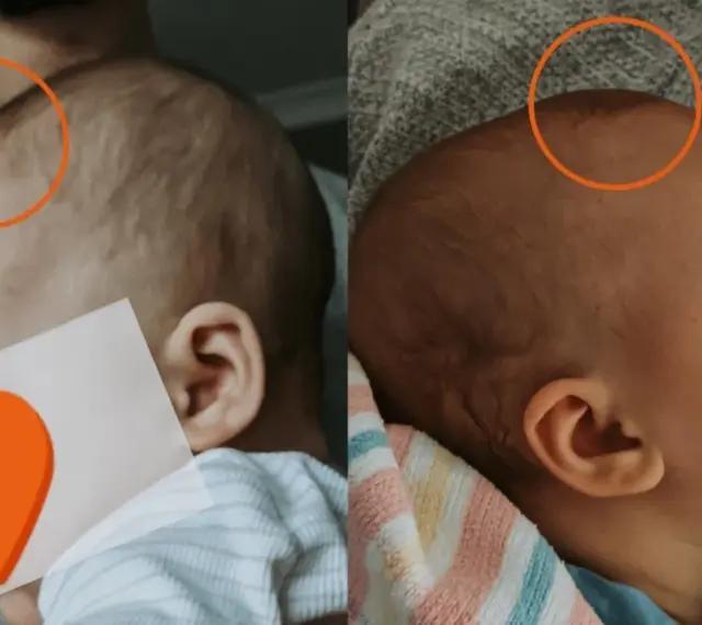 Dwa ujęcia główki niemowlaka, pokazujące jak zarasta ciemiączko. Na pierwszym zdjęciu ciemiączko jest bardziej widoczne, na drugim już się zamyka.