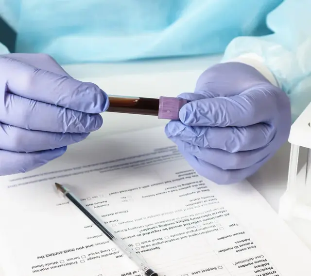Ręce w rękawiczkach trzymają probówkę z krwią. Wyniki badań wskazują na eozynofile niskie, co może wymagać dalszej diagnostyki.