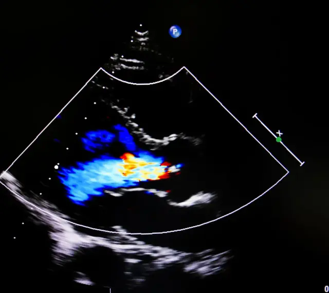 Obraz USG serca z kolorowym Dopplerem, pokazujący przepływ krwi. Może być pomocny w diagnostyce przewlekłej niewydolności żylnej.