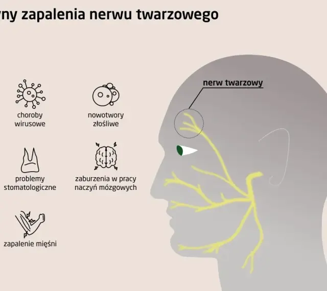 Ilustracja przedstawia przyczyny zapalenia nerwu twarzowego, w tym neuralgia nerwu trójdzielnego, choroby wirusowe, nowotwory, problemy stomatologiczne, zaburzenia naczyń mózgowych i zapalenie mięśni.