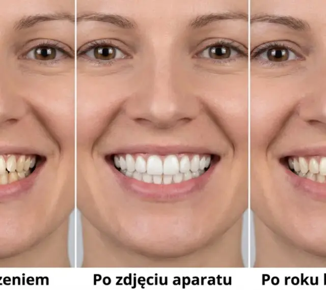 Uśmiech przed leczeniem, po zdjęciu aparatu i po roku bez retencji. Widać różnicę w prostowaniu zębów i utrzymaniu efektu.
