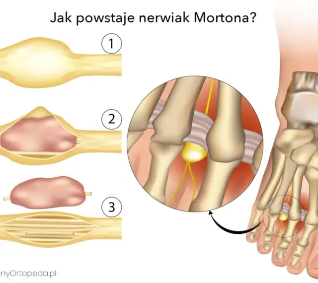 Ilustracja pokazuje powstawanie nerwiaka Mortona: zgrubienie nerwu w stopie, które może powodować ból.