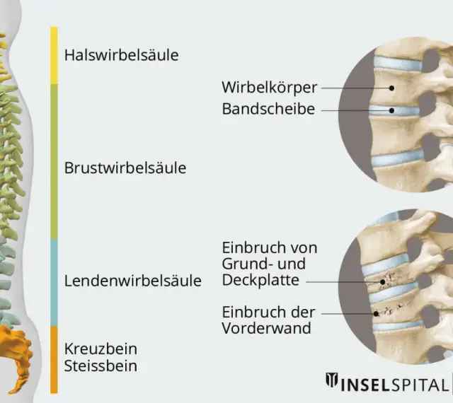 Illustration der Wirbelsäule mit Darstellung eines Wirbelbruchs. Mögliche wirbelbruch symptome werden durch die gezeigten Frakturen verdeutlicht.