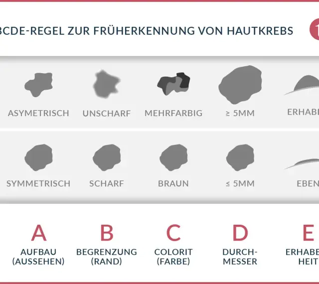 ABCDE-Regel zur Früherkennung von Hautkrebs: Asymmetrie, Begrenzung, Colorit, Durchmesser, Erhabenheit. Hilft, Hautkrebs frühzeitig zu erkennen.