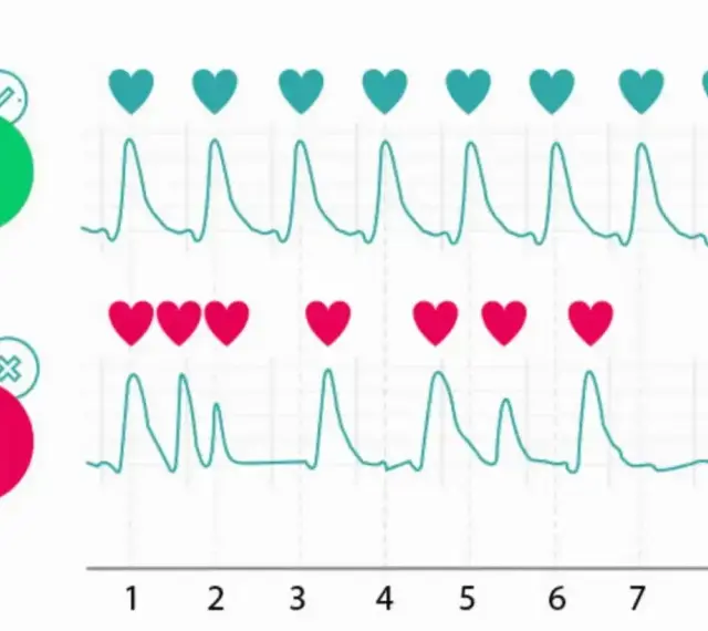 Dwa wykresy EKG pokazują rytm serca. Górny wykres z zielonym sercem i 60 BPM jest prawidłowy. Dolny z czerwonym sercem i 60 BPM ma nieregularny rytm.