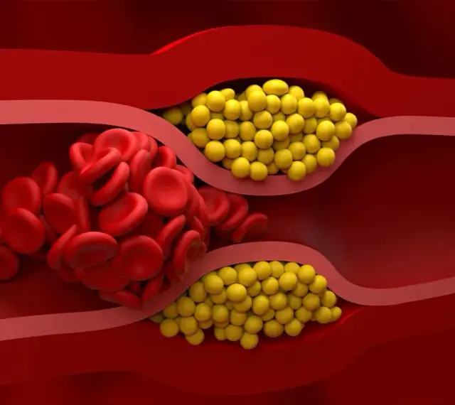 Zator w naczyniu krwionośnym: czerwone krwinki i żółte złogi. Badanie lipoproteiny pomoże ocenić ryzyko.