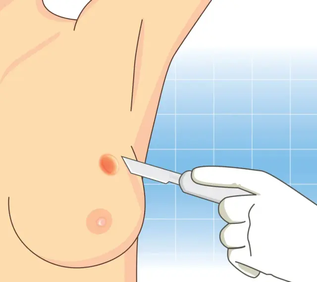 Ilustracja przedstawia biopsję piersi, gdzie skalpel zbliża się do zmiany na skórze.
