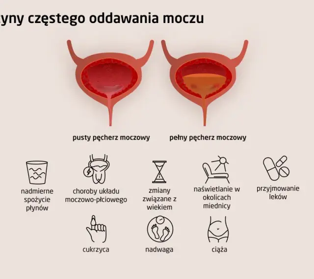 Ilustracja pokazuje przyczyny częstego oddawania moczu: nadmierne picie, choroby układu moczowo-płciowego, wiek, naświetlanie, leki, cukrzyca, nadwaga, ciąża.