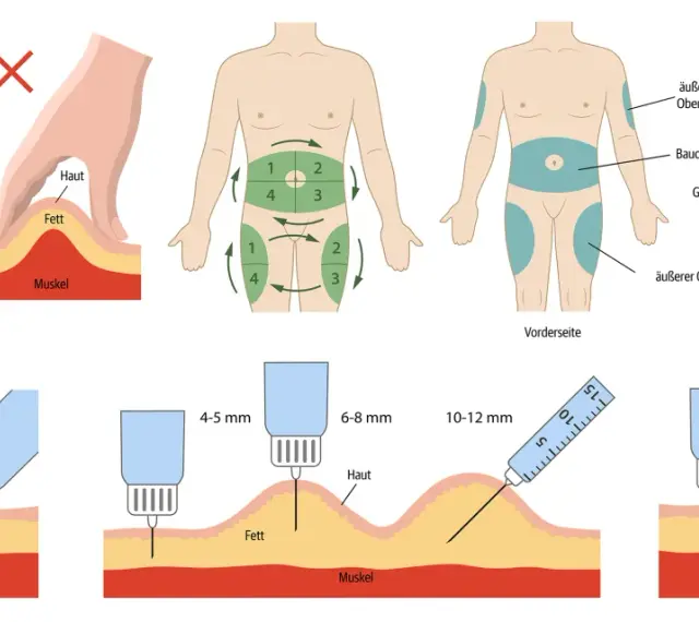 Anleitung: wie spritze ich Insulin richtig in den Oberschenkel. Zeigt Hautfalte, Injektionswinkel (90°/45°), Nadellänge und Körperstellen.