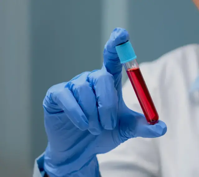 Ręka w niebieskiej rękawiczce trzyma probówkę z czerwoną cieczą. To może być próbka do badań, np. PDW co to jest, czyli wskaźnik anizocytozy płytek krwi.