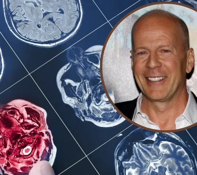 Bruce Willis choroba: obraz rezonansu magnetycznego mózgu obok uśmiechniętej twarzy aktora.