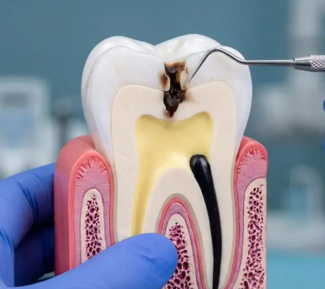 Model zęba pokazuje zaawansowaną próchnicę, która dotarła do miazgi. Dentysta w niebieskiej rękawiczce bada ubytek.