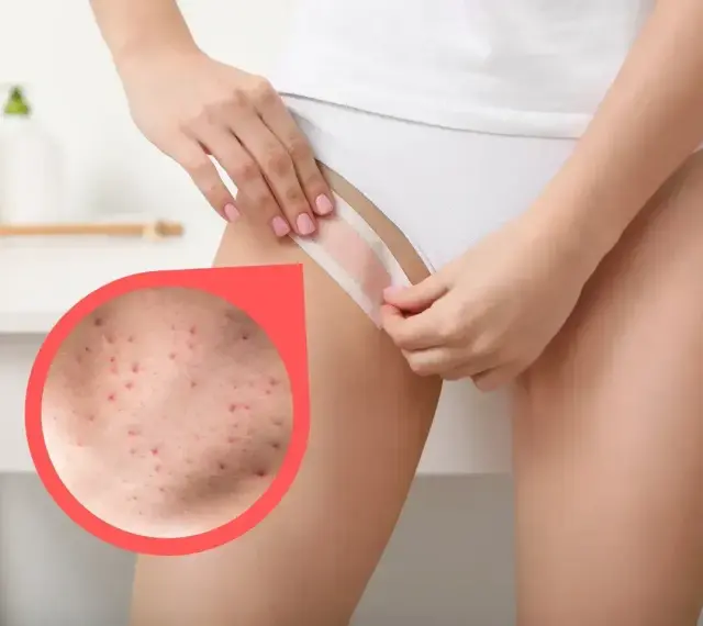Zbliżenie na skórę z widocznymi krostkami po goleniu. Kobieta poprawia bieliznę, ukazując problem.