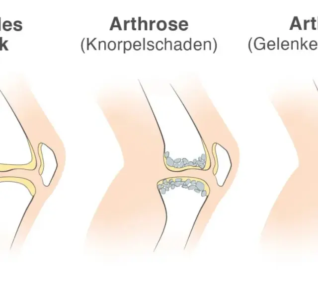 Vergleich von Gelenken: gesund, Arthrose (Knorpelschaden) und Arthritis (Gelenkentzündung). Arthritis zeigt eine Entzündung im Gelenk.