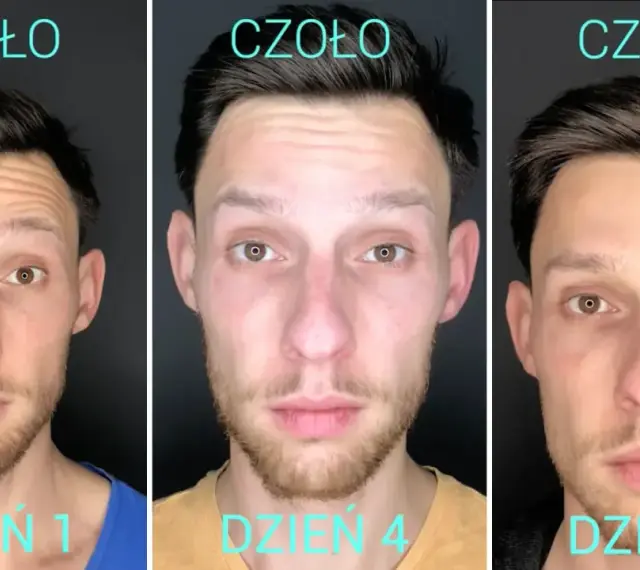 Trzy zdjęcia mężczyzny pokazujące efekt botoksu na czoło: dzień 1 (zmarszczki), dzień 4 (zmniejszone zmarszczki), dzień 7 (gładkie czoło).