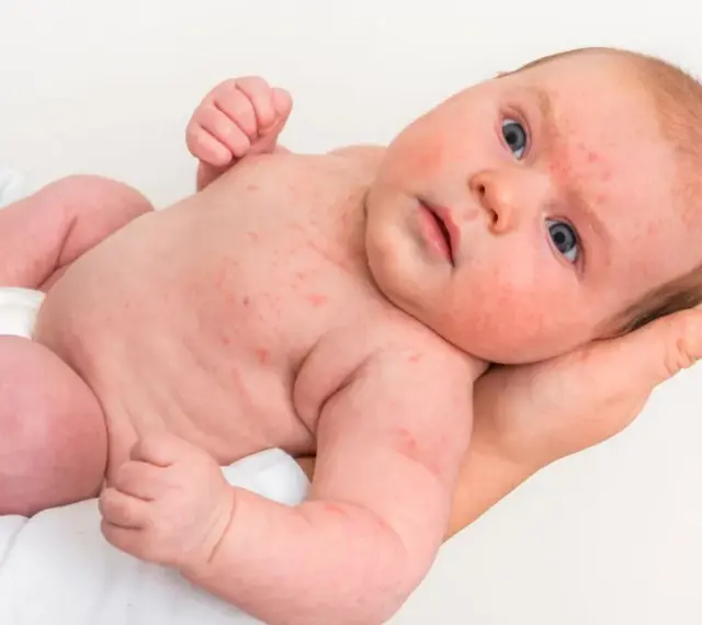 Niemowlę z widoczną wysypką alergiczną na twarzy i ciele. Czerwone plamki pokrywają skórę, wskazując na reakcję alergiczną u dziecka.