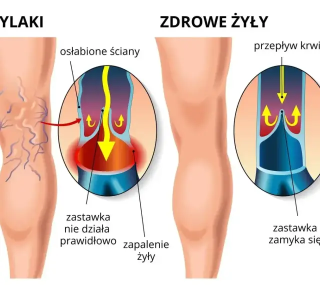 Ilustracja pokazuje nogę z żylakami i zdrową nogę. Flebolog wyjaśnia, że przy żylakach zastawki nie działają, powodując zapalenie.