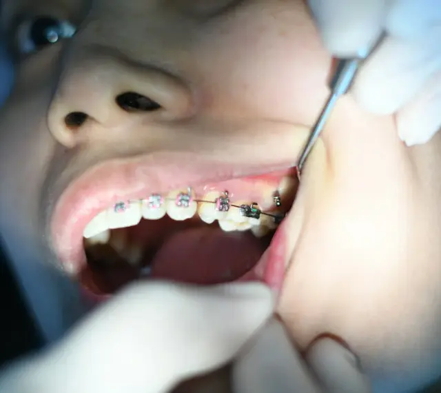 Aparat samoligaturujący wady zgryzu. Dentyści korygują zęby.