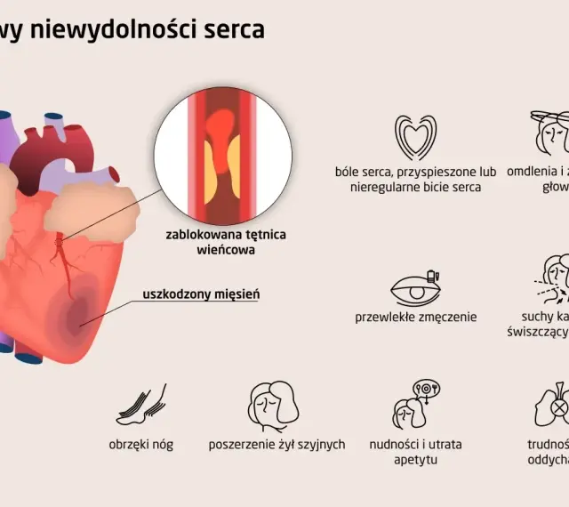 Objawy niewydolności serca: ból w klatce, omdlenia, zmęczenie, obrzęki nóg, kaszel, duszności, nudności. Zablokowana tętnica wieńcowa i uszkodzony mięsień sercowy.