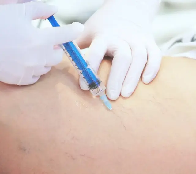 Lekarz w białej rękawiczce wykonuje zastrzyk strzykawką w nogę z widocznymi naczynkami. To skleroterapia żylaków opinie.