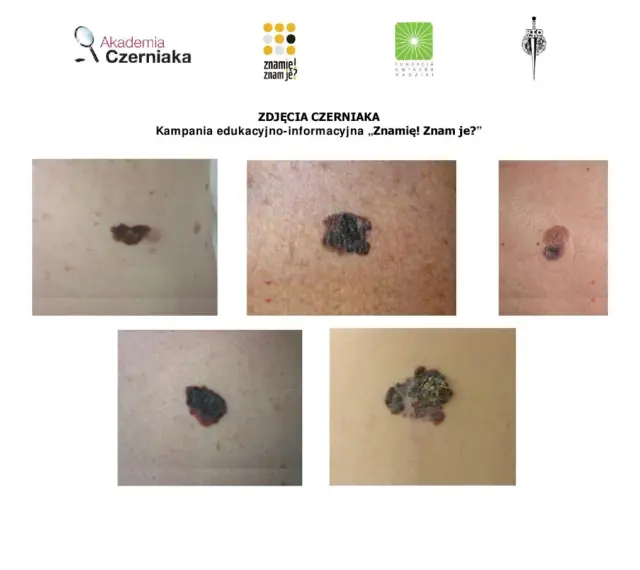 Zbliżenia różnych znamion i czerniaków na skórze.