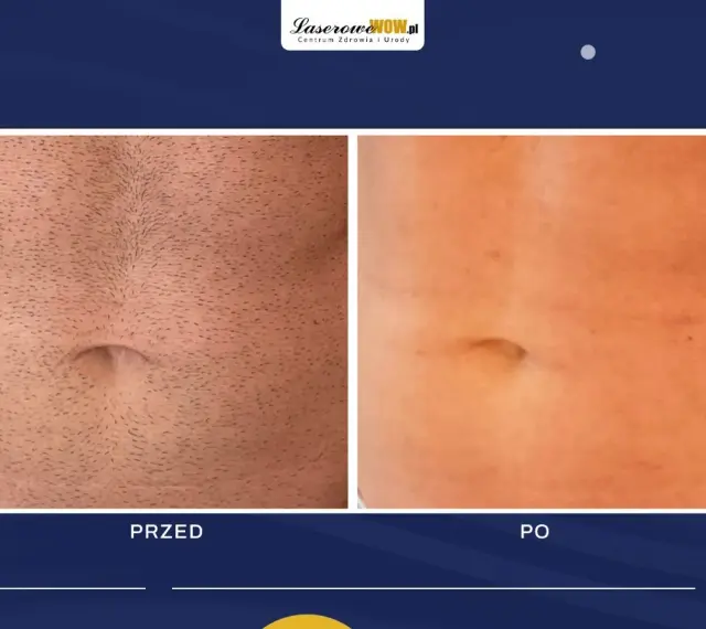 Przed i po depilacji laserowej brzucha. Widoczne spektakularne efekty redukcji owłosienia.