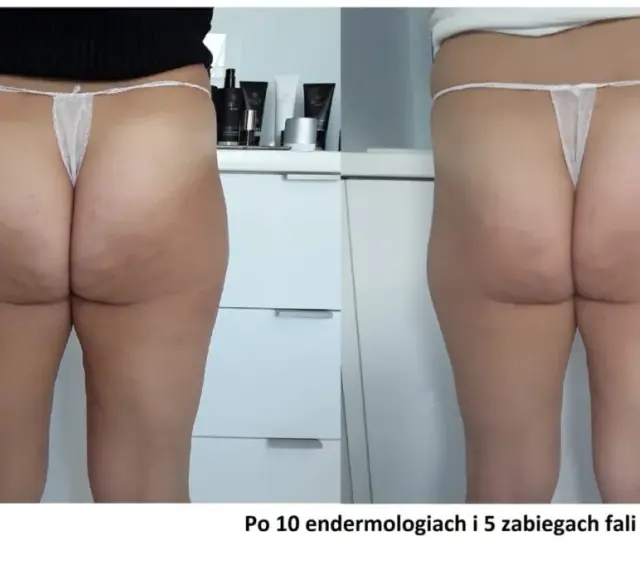 Widoczne efekty endermologii po 10 zabiegach i 5 fal akustycznych na uda. Skóra na pośladkach i udach jest gładsza, cellulit zredukowany.
