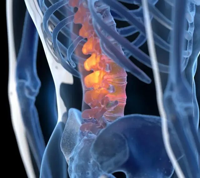 Anatomical rendering of a human spine with inflamed vertebrae, highlighted in orange and red.