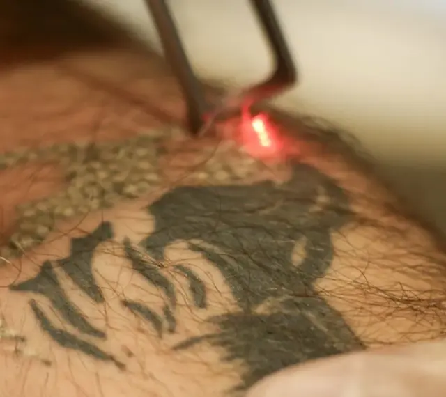 Laser usuwanie tatuażu. Czerwony promień lasera rozjaśnia ciemny wzór na skórze, rozpoczynając proces usuwania tatuażu.