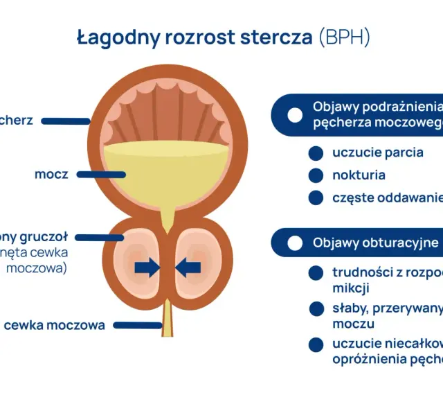 Ilustracja pokazuje łagodny rozrost stercza (BPH) i jego objawy. Prostata, czyli gruczoł krokowy, powiększa się, uciskając cewkę moczową.