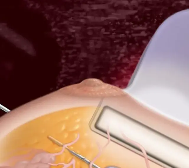 Ilustracja przedstawia biopsję mammotomiczną piersi z użyciem sondy ultradźwiękowej i igły.