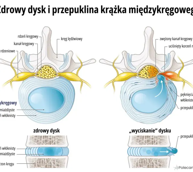 Pęknięcie pierścienia włóknistego objawy: przepuklina jądra miażdżystego uciska korzeń nerwowy, powodując zwężenie kanału kręgowego.