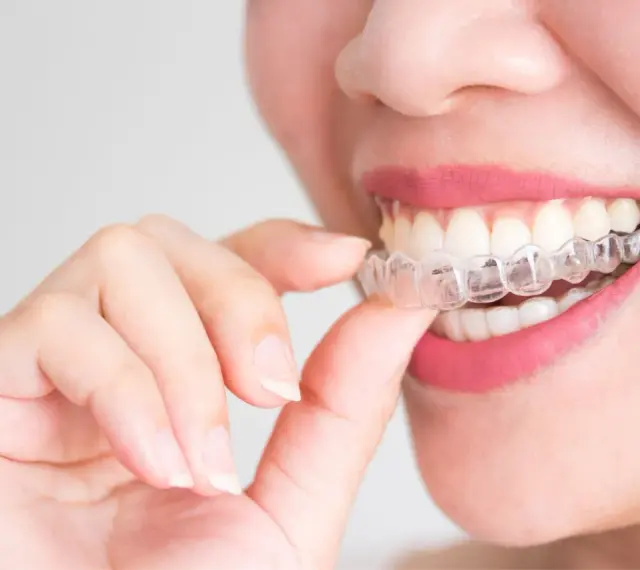 Kobieta z różowymi ustami zakłada przezroczysty aparat Invisalign na zęby.