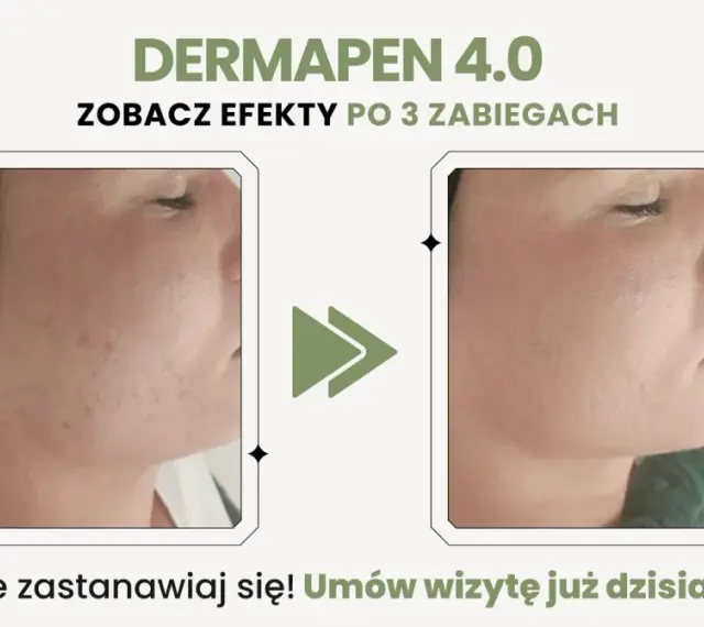 Dermapen 4.0 na co? Zobacz efekty po 3 zabiegach: skóra wygładzona, bez niedoskonałości. Umów wizytę!