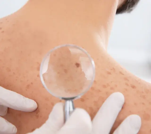 Dermatolog bada znamię na plecach pacjenta przez lupę. Skóra pokryta jest licznymi piegami i znamionami.