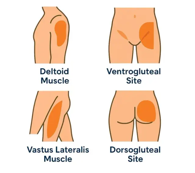 Illustration zeigt Injektionsstellen für eine Muskel-Spritze: Deltamuskel, Ventrogluteal, Vastus lateralis und Dorsogluteal.