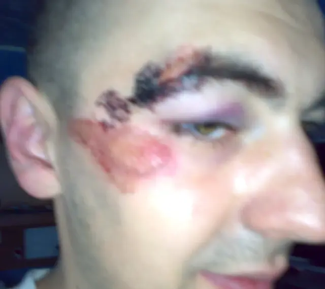 Rozcięty łuk brwiowy z siniakiem i otarciem na policzku.