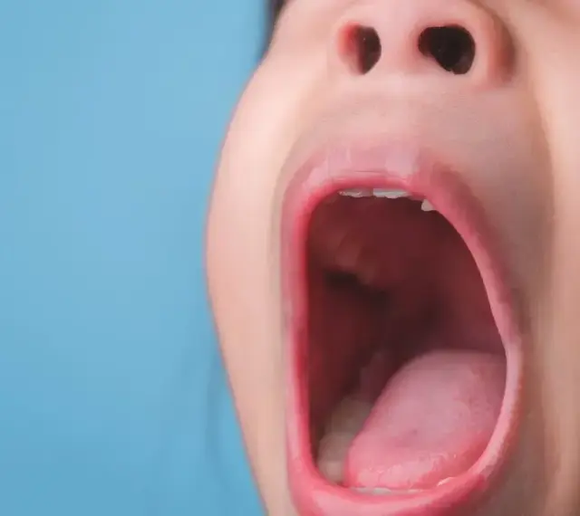 Dziecko krzyczy z bólu, bo ma poparzone podniebienie.