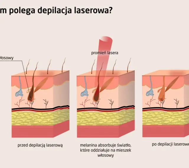 Ilustracja pokazuje, jak działa depilacja laserowa. Czy depilacja laserowa jest bezpieczna? Laser celuje w melaninę we włosie, niszcząc go.
