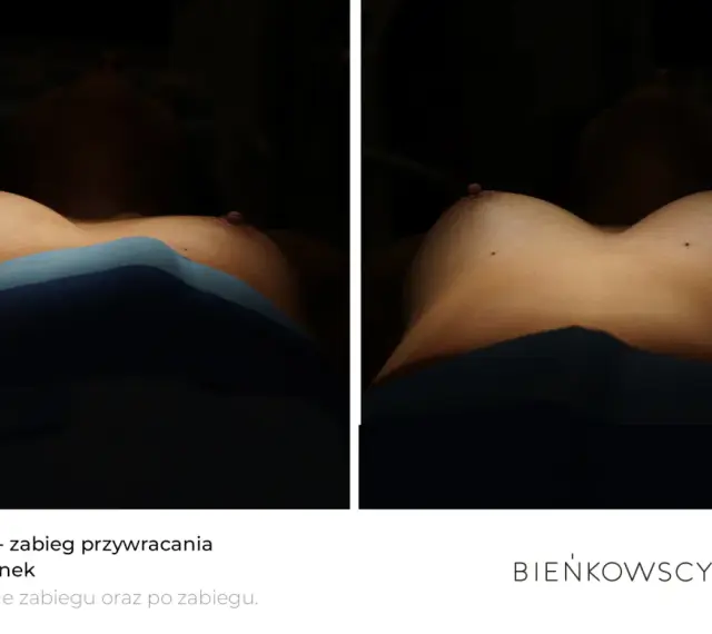 Lipotransfer biustu: porównanie efektów przed i po zabiegu. Widoczne piersi z zaznaczonymi punktami.