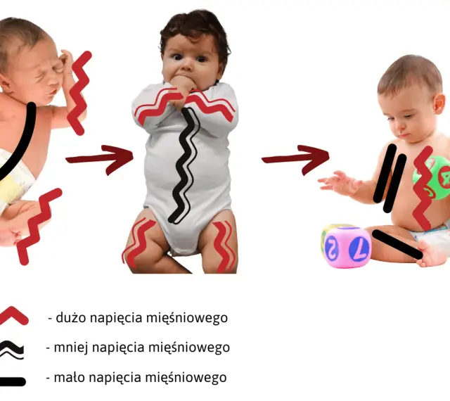 Zmiana napięcia mięśniowego u niemowląt: od dużego napięcia do mniejszego, a potem do małego.