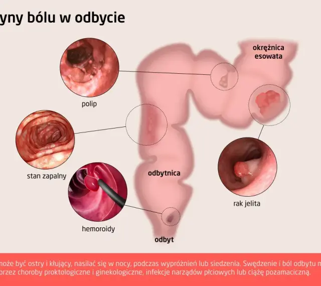 Ilustracja pokazuje przyczyny bólu w odbycie: polip, stan zapalny, hemoroidy, raka jelita, okrężnicę esowatą.