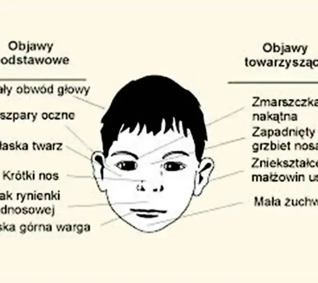 Ilustracja przedstawia cechy twarzy dziecka z FASD: mały obwód głowy, płaska twarz, krótki nos, wąska górna warga, zmarszczka nakątna, zapadnięty grzbiet nosa.