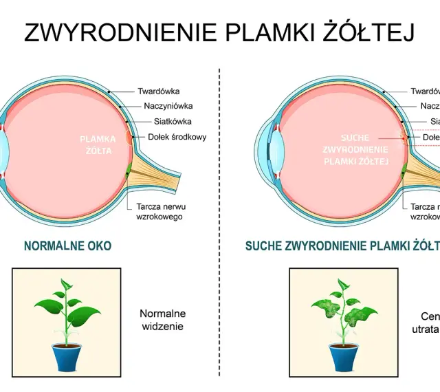 Porównanie zdrowego oka z suchym zwyrodnieniem plamki żółtej. Pokazuje, jak szybko powiększa się otwór plamki żółtej, prowadząc do utraty wzroku.