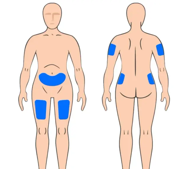 Körperstellen für Injektionen: Bauch, Oberschenkel, Oberarme und Gesäß. So kann man weit spritzen.